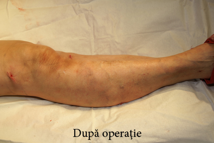Dupa operatie de varice! | Forumul Medical ROmedic - După operație piciorul varicos umflă piciorul